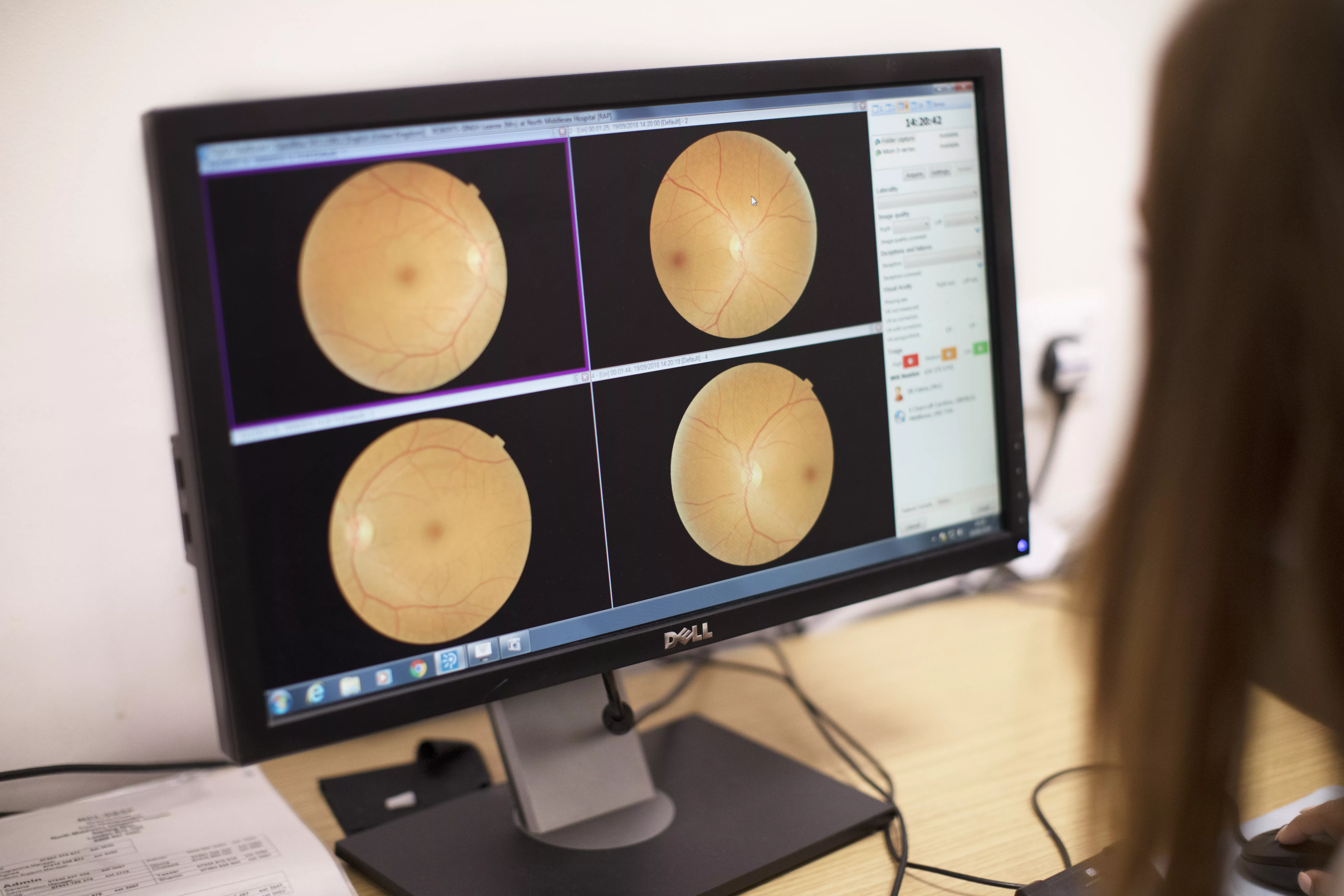Picture of a retinal photograph on a computer screen